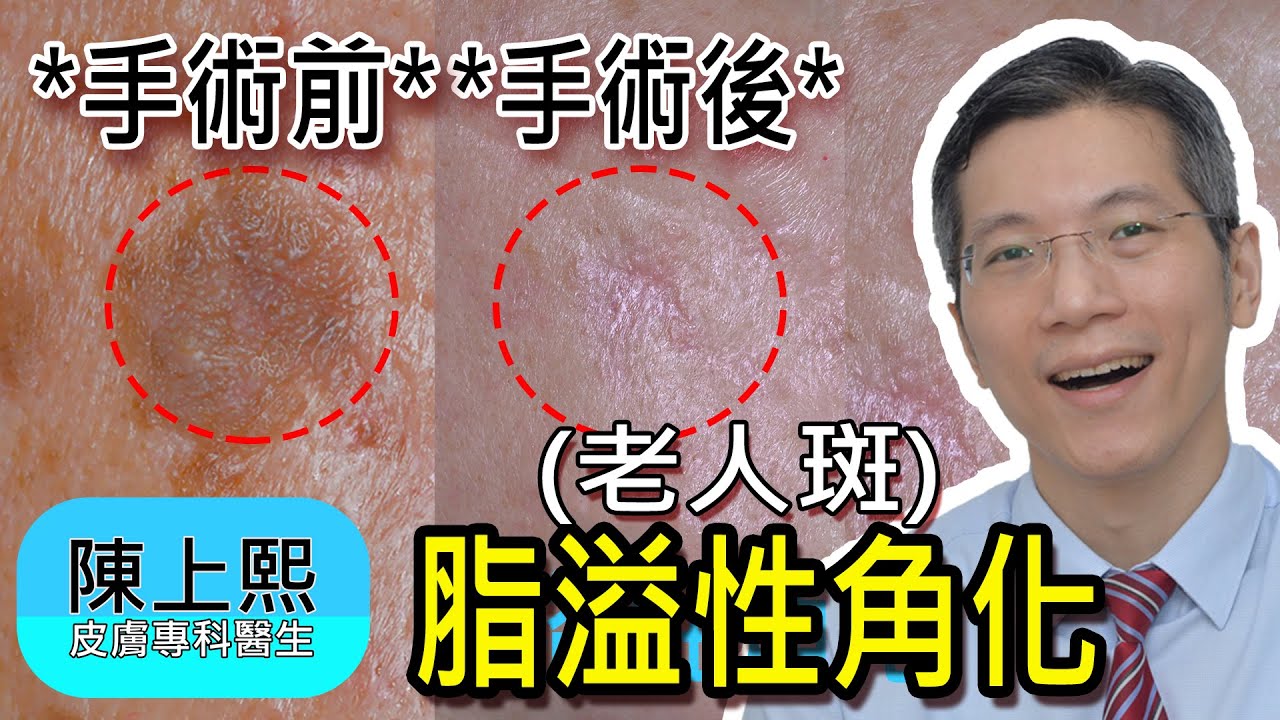老人斑 脂溢性角化 手術前後對比