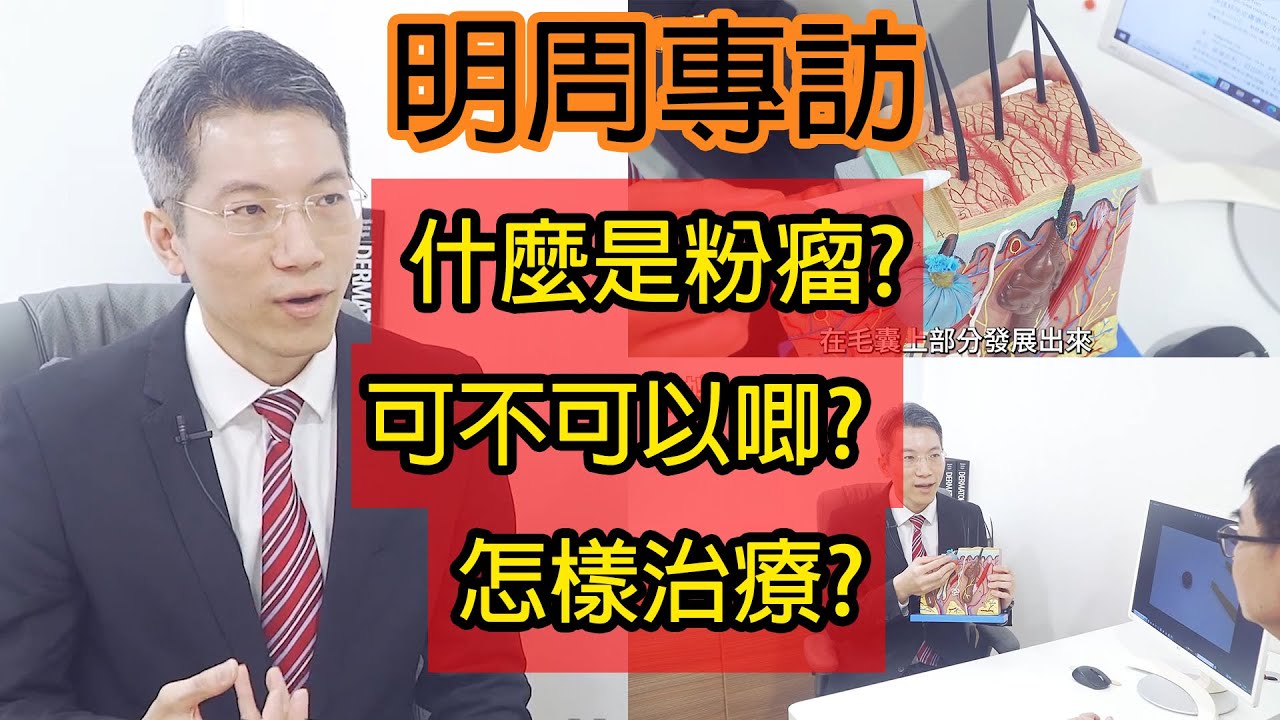 明周專訪 什麽是粉瘤？這樣治療