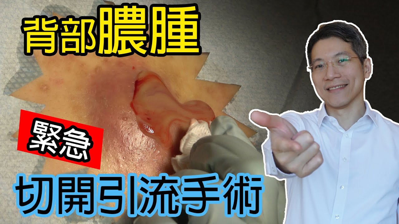 背部膿腫緊急切開引流手術