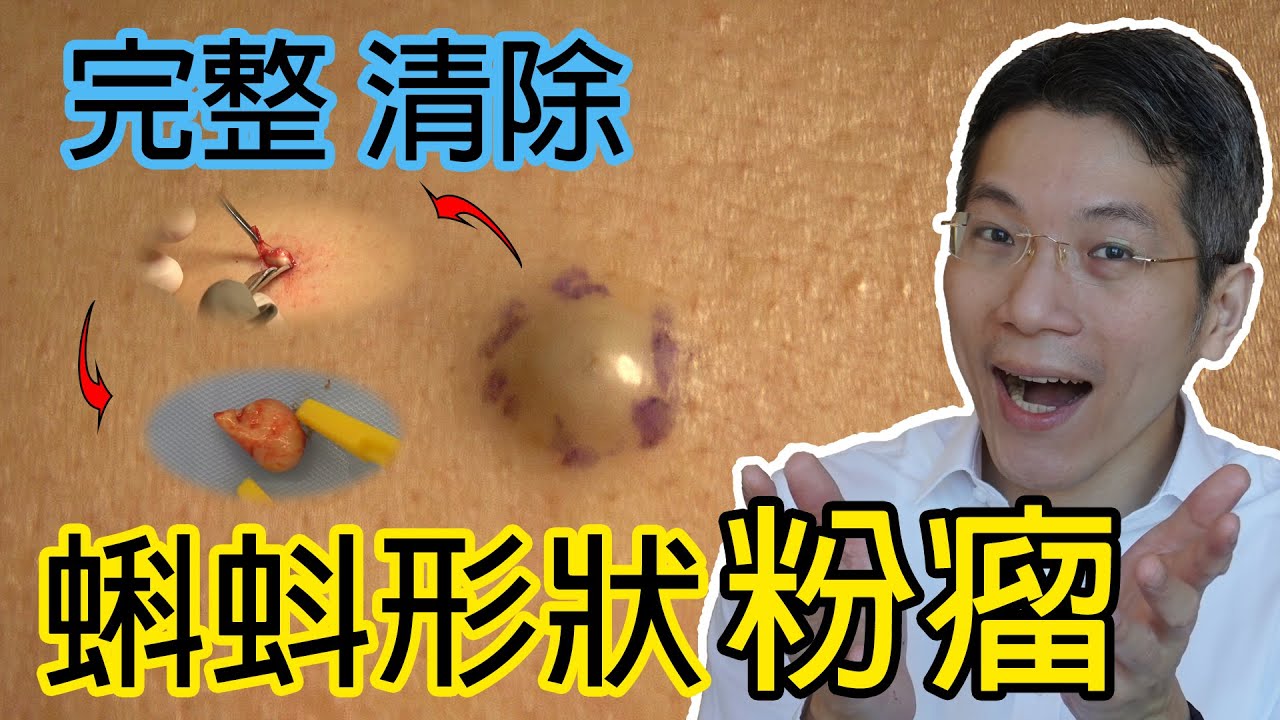 蝌蚪形狀粉瘤