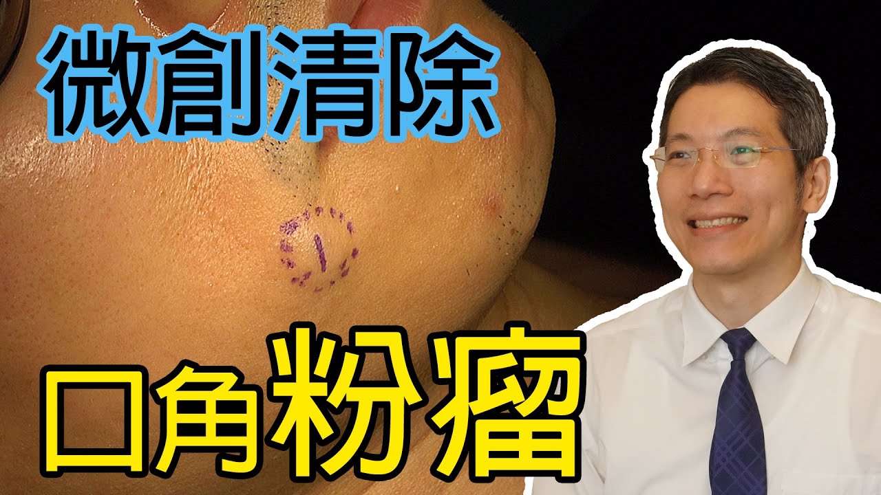 微創清除口角粉瘤
