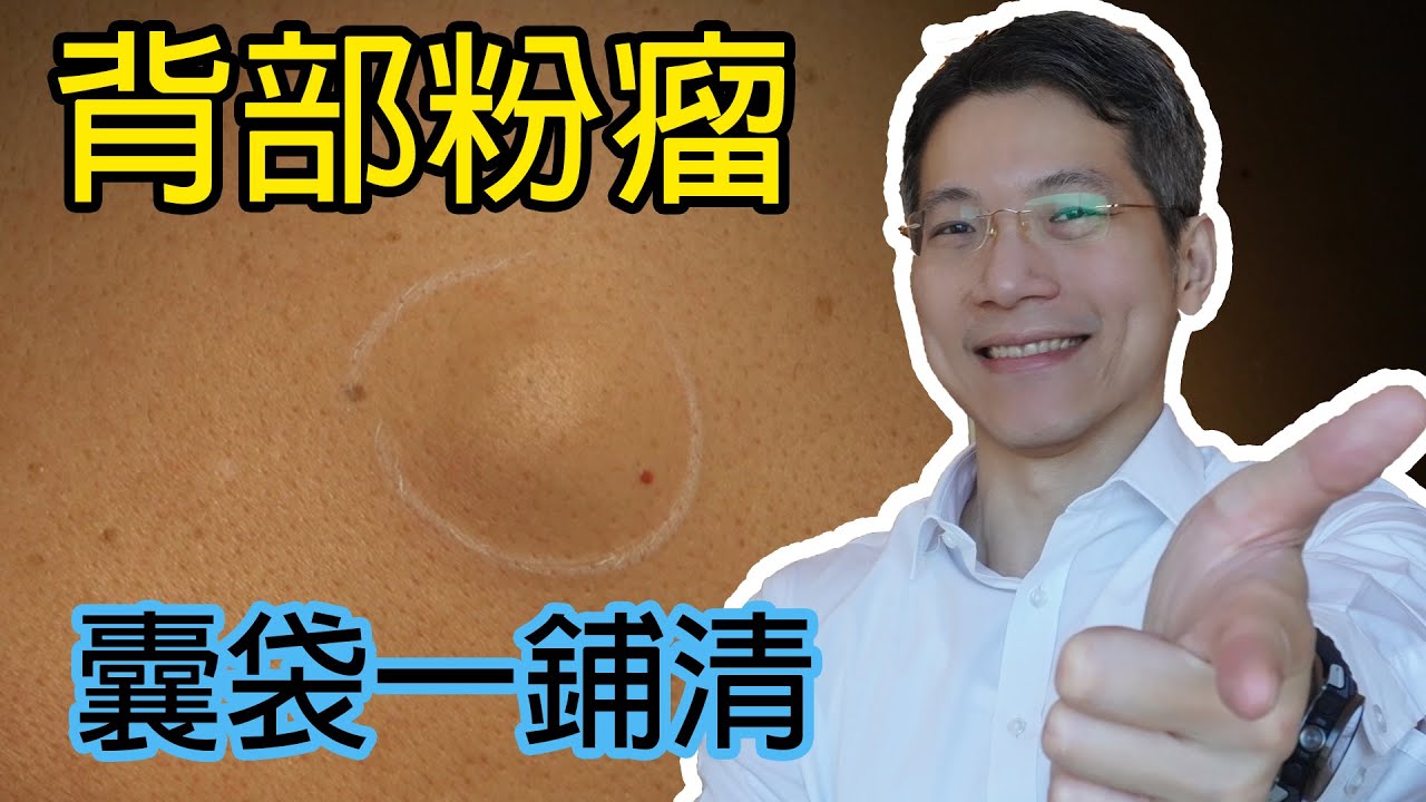 背部粉瘤囊袋一鋪清