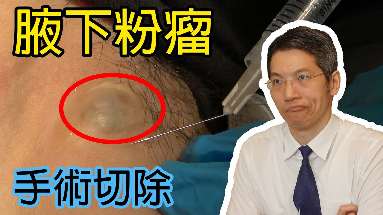 腋下粉瘤