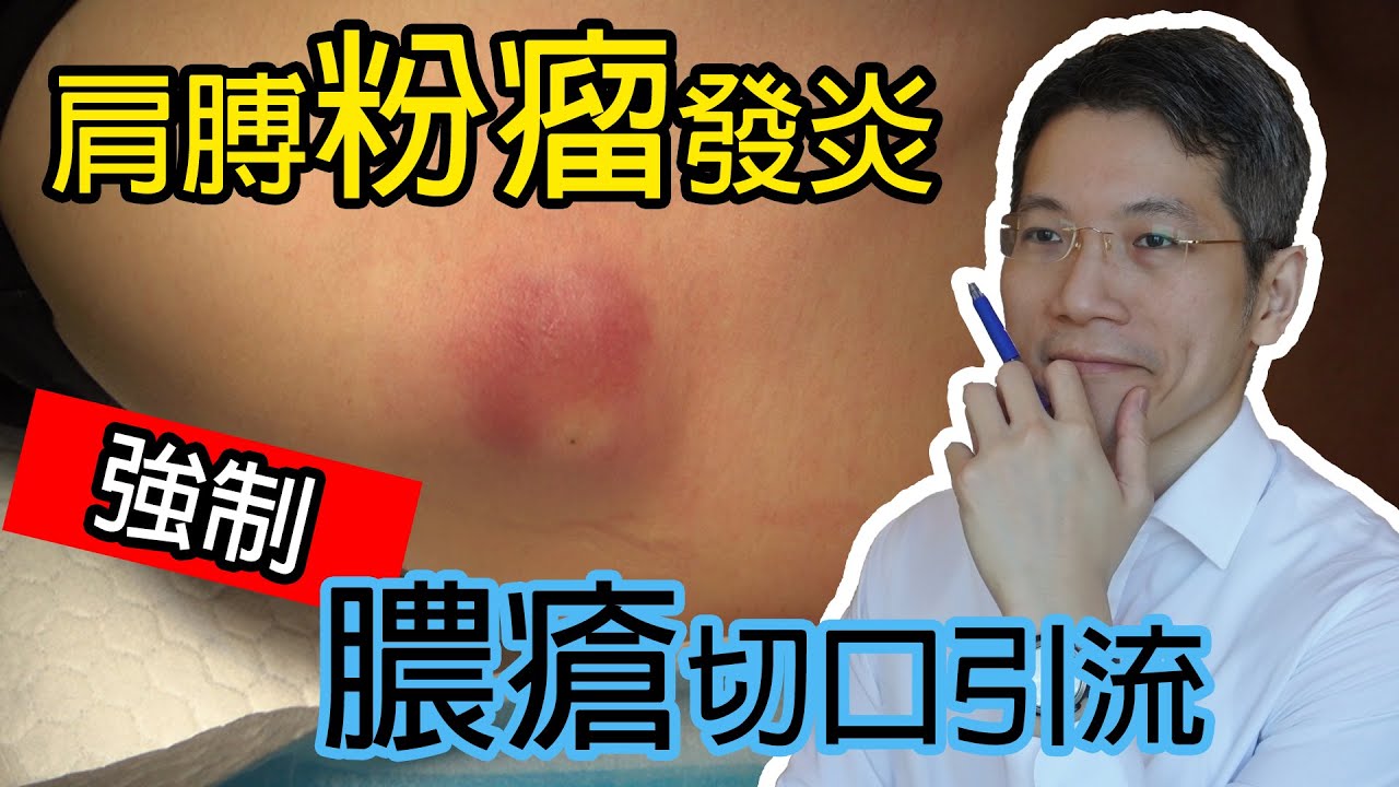 肩膊粉瘤發炎 強制膿瘡切口引流