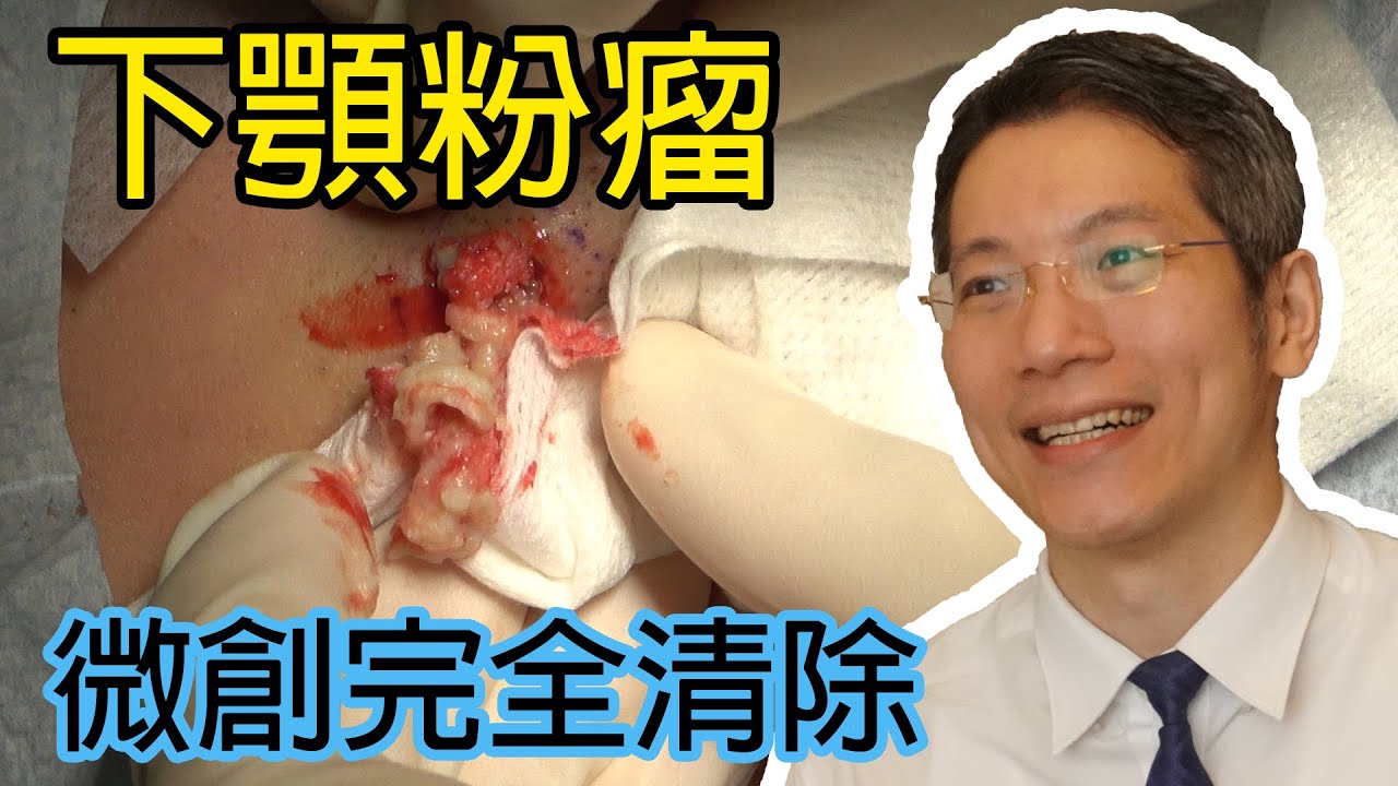 下颚粉瘤微創完整切除