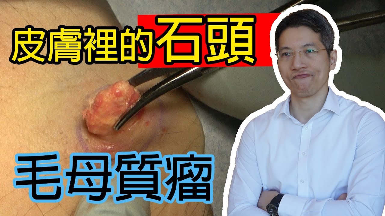 皮膚裏的石頭毛母質瘤
