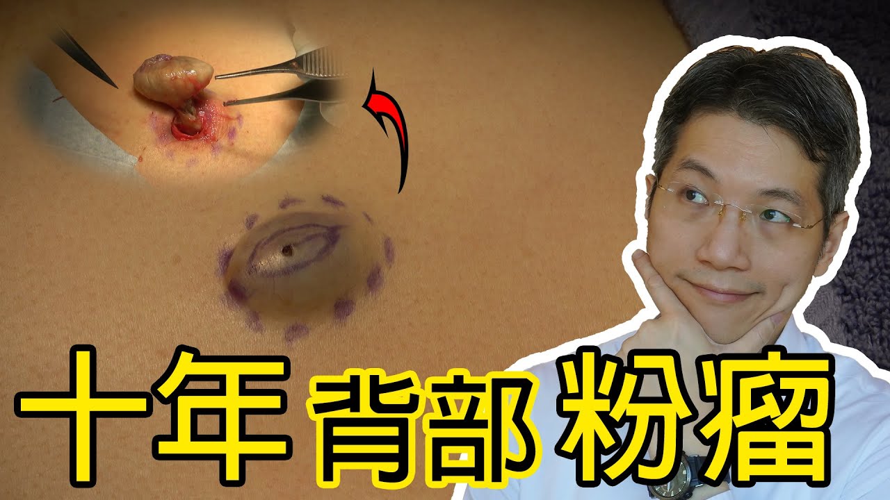 十年背部粉瘤