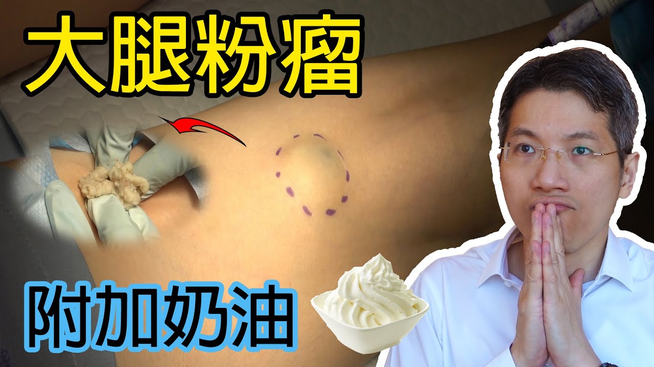 大腿粉瘤