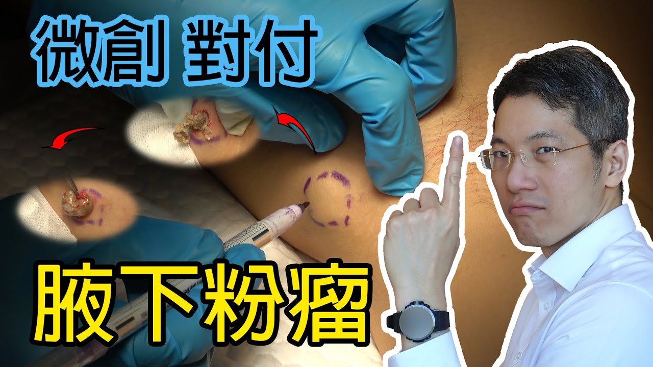 微創對付腋下粉瘤
