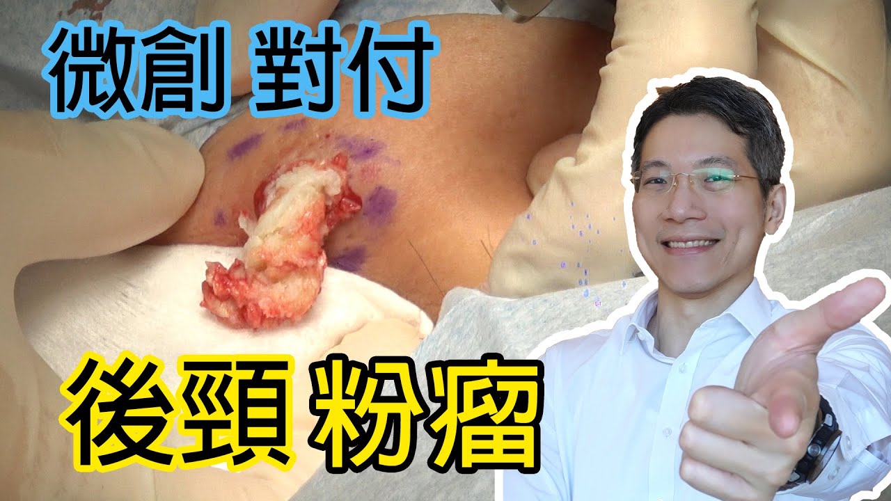 微創對付後頸粉瘤