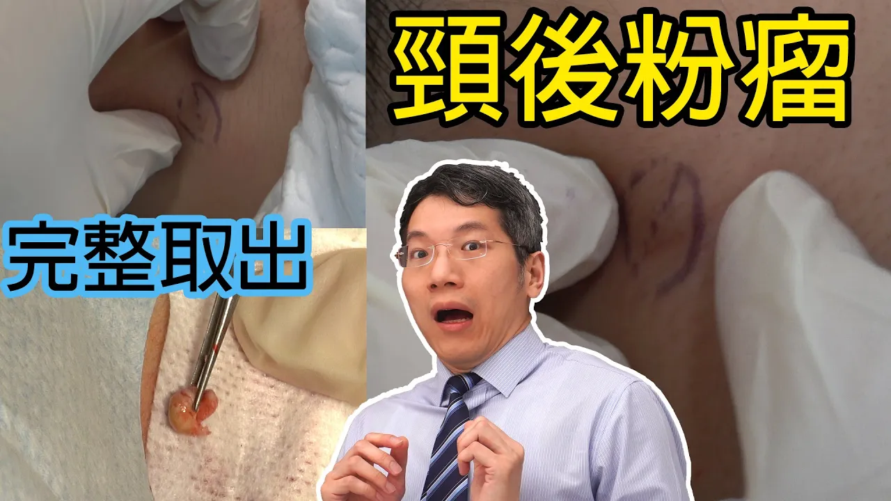 頸後粉瘤完整取出