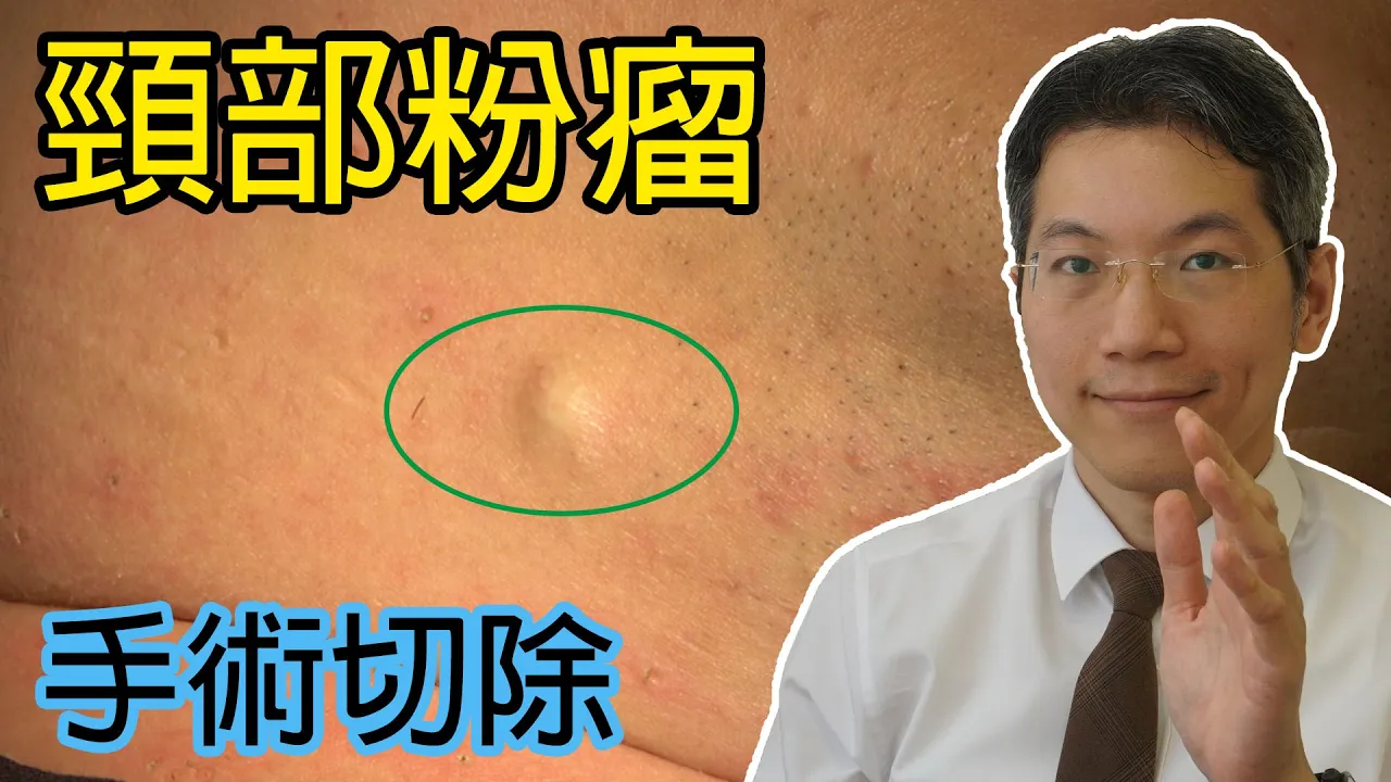 頸部粉瘤