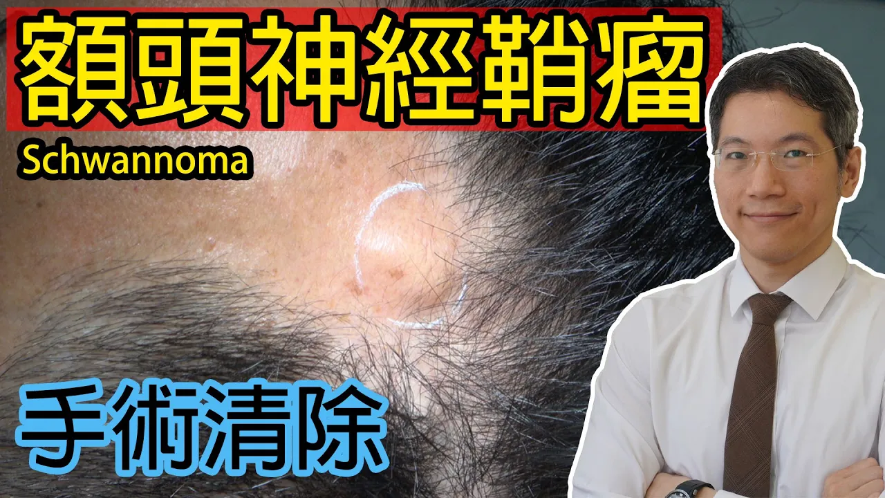 額頭神經鞘瘤 手術清除