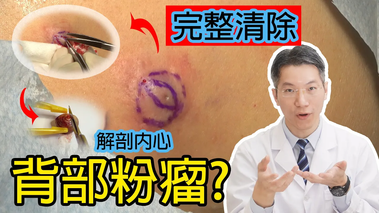 背部粉瘤 完整清除