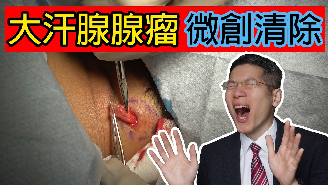 大汗腺腺瘤微創清除