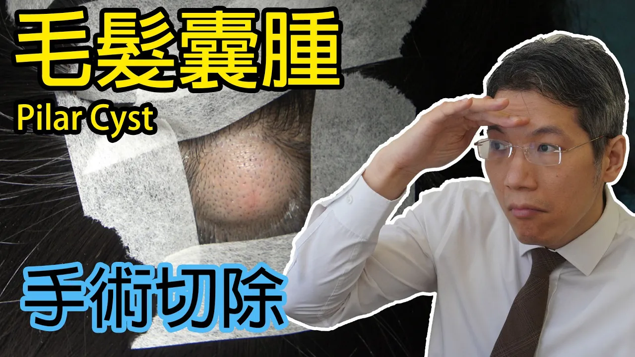 毛髮囊腫 手術切除