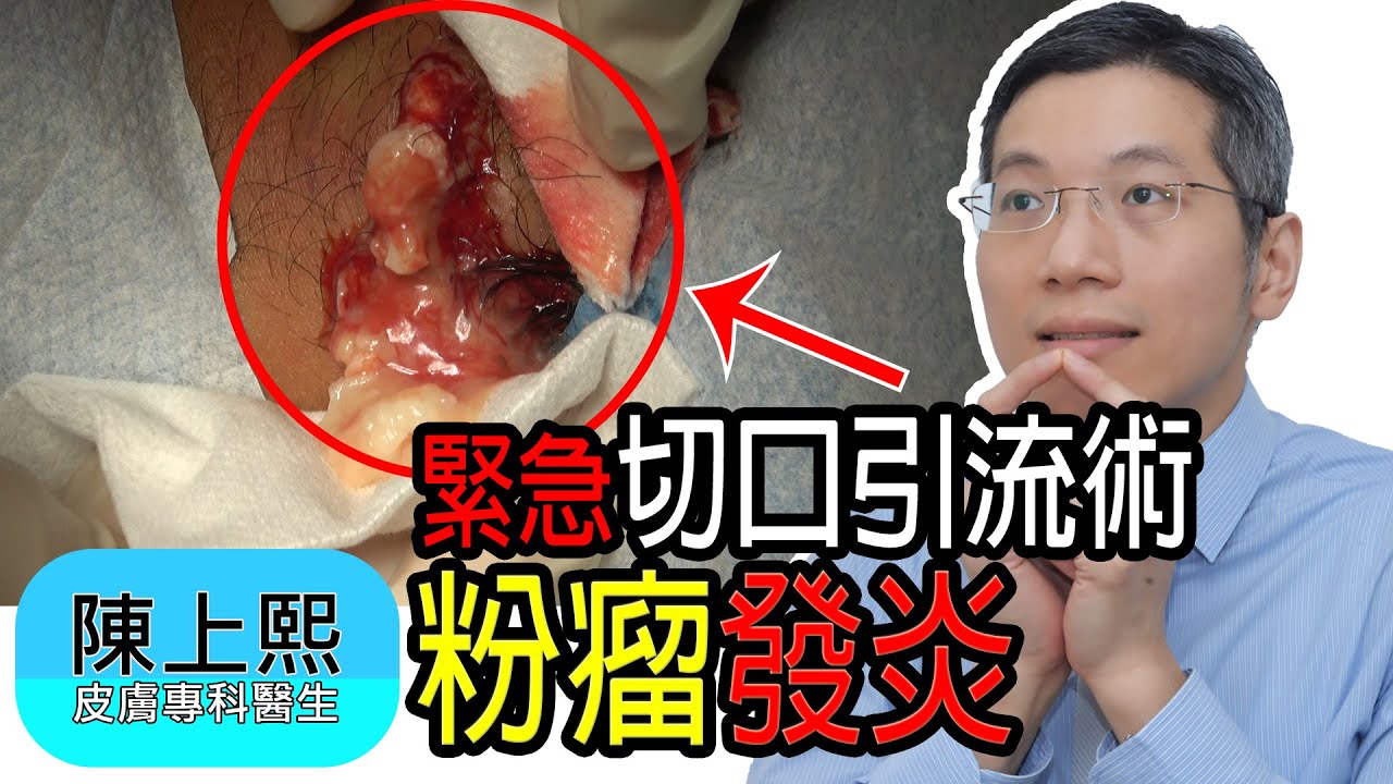 粉瘤發炎點算好？