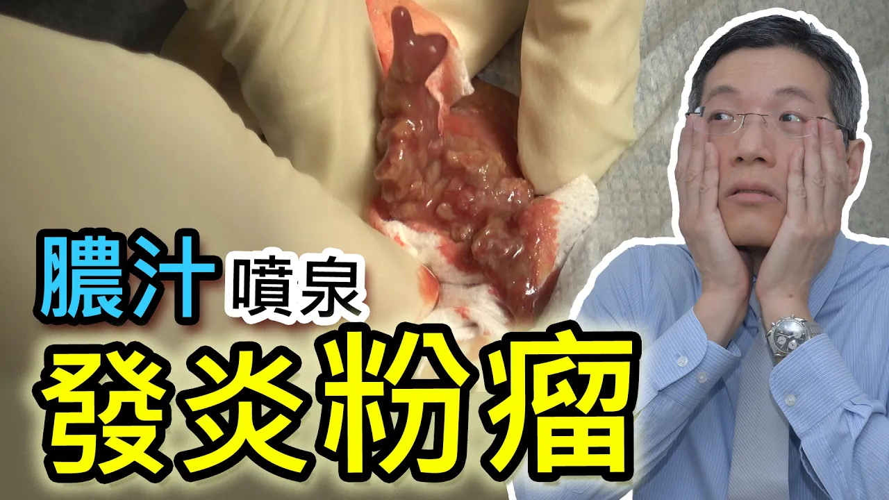 膿汁噴泉背後的元凶發炎粉瘤