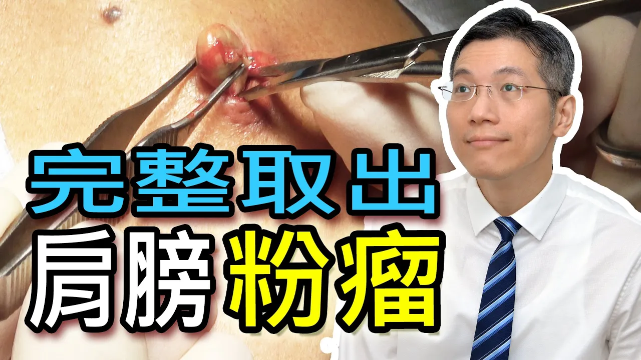 完整取出肩膀粉瘤