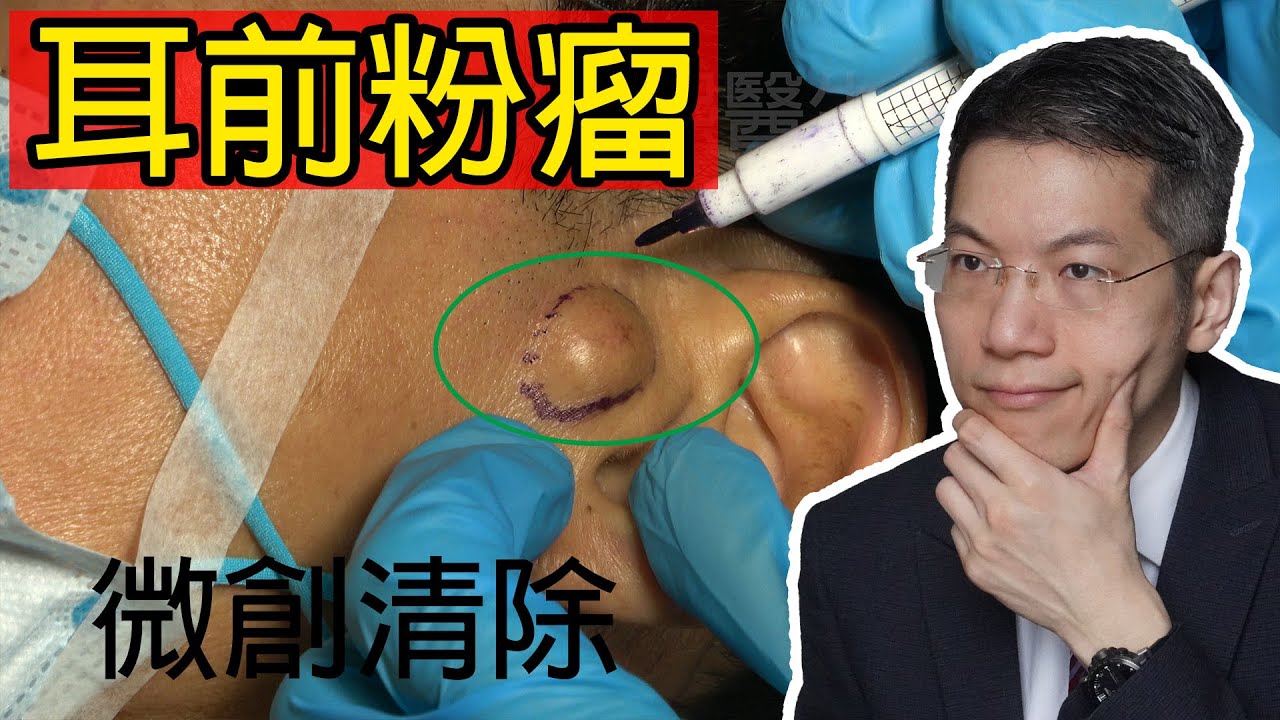 耳前粉瘤
