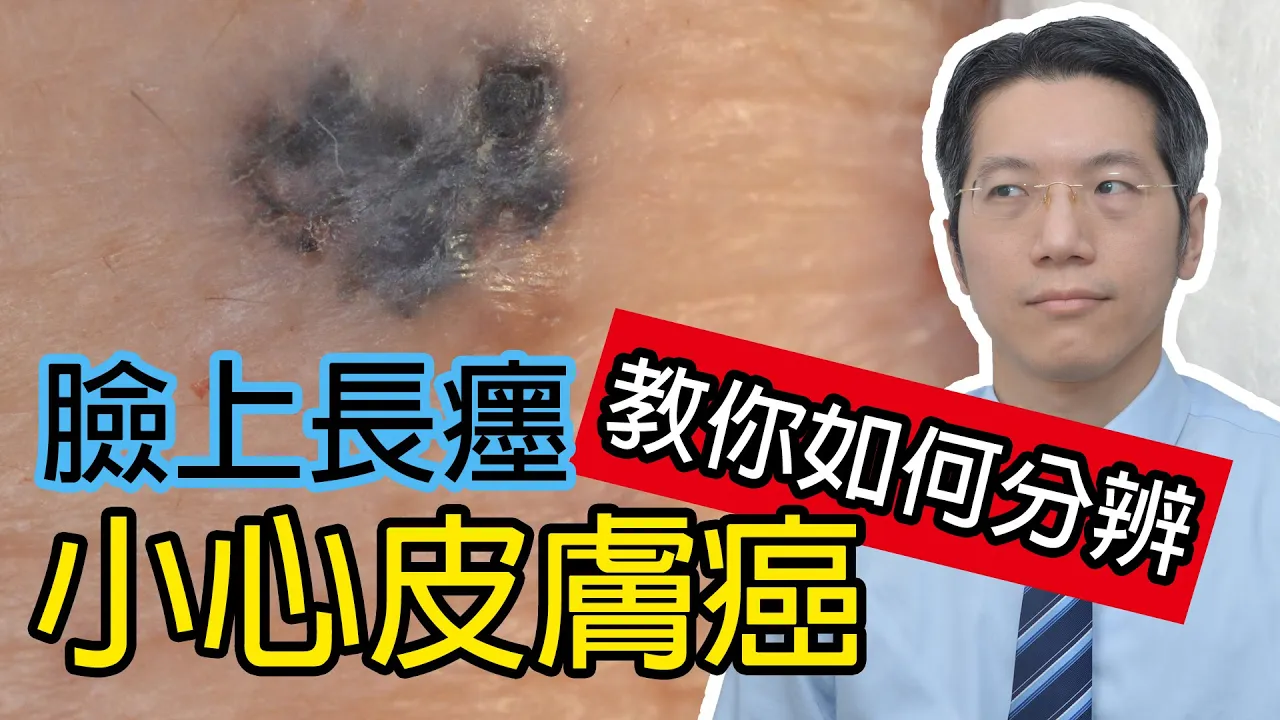 臉上長癦?小心皮膚癌!