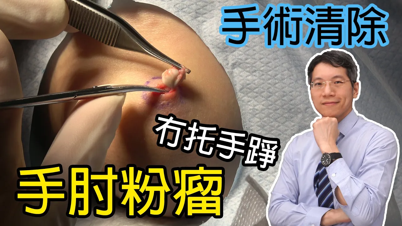 手肘粉瘤真係冇托手踭