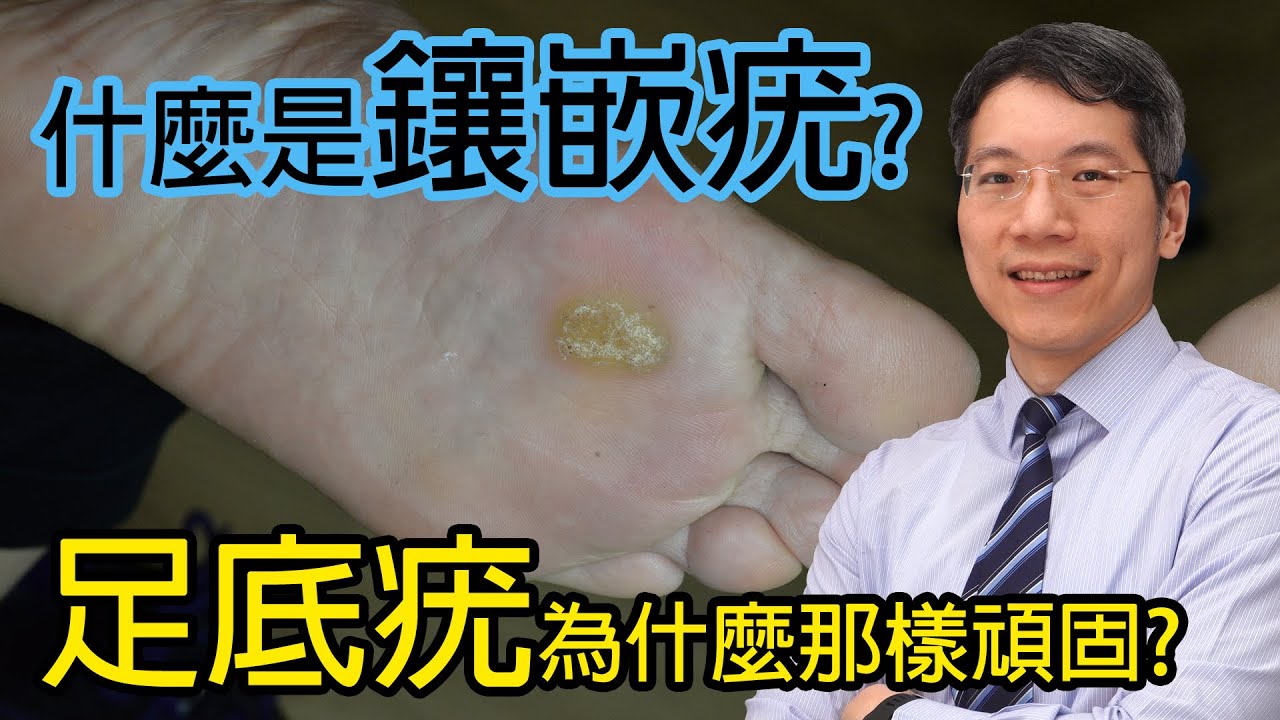 什麽是鑲嵌疣？