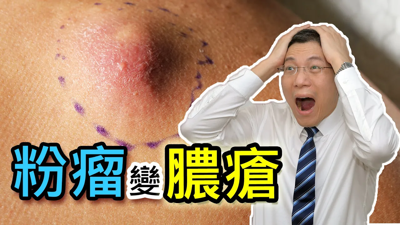 粉瘤變膿瘡？