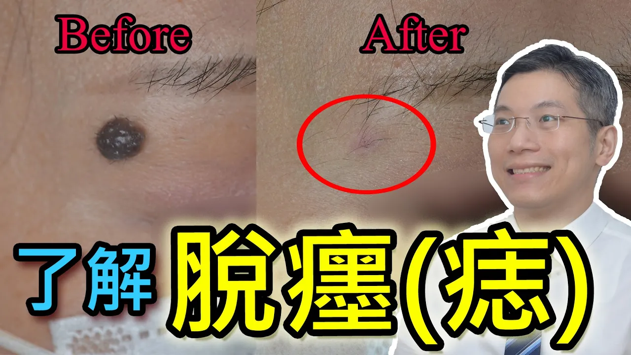 二氧化碳激光脫痣/脫墨