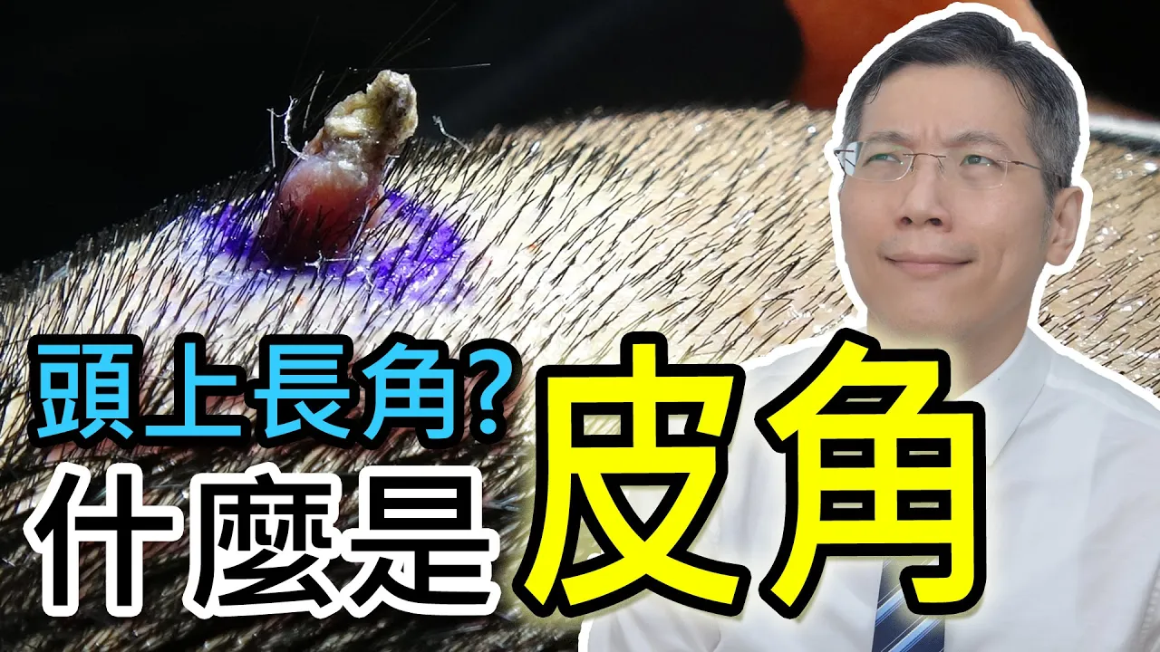 頭上長角？什麽是皮角？