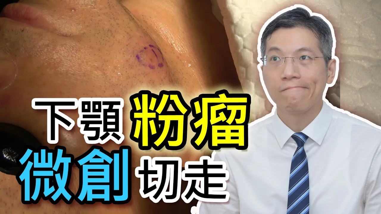 下巴粉瘤 微創切走