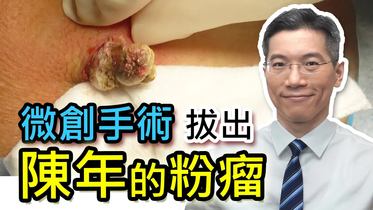 陳年的粉瘤