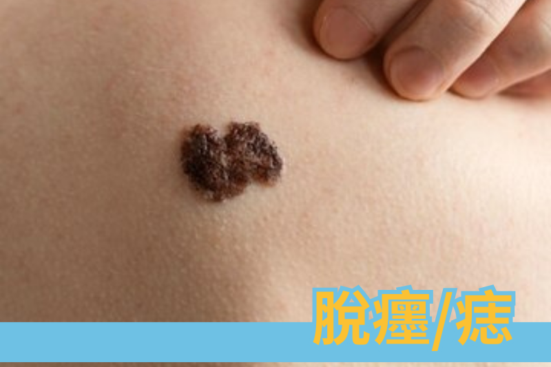 脫癦/痣知多少？