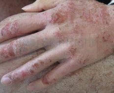 skin-problem-濕疹_皮膚炎-img-53-2x