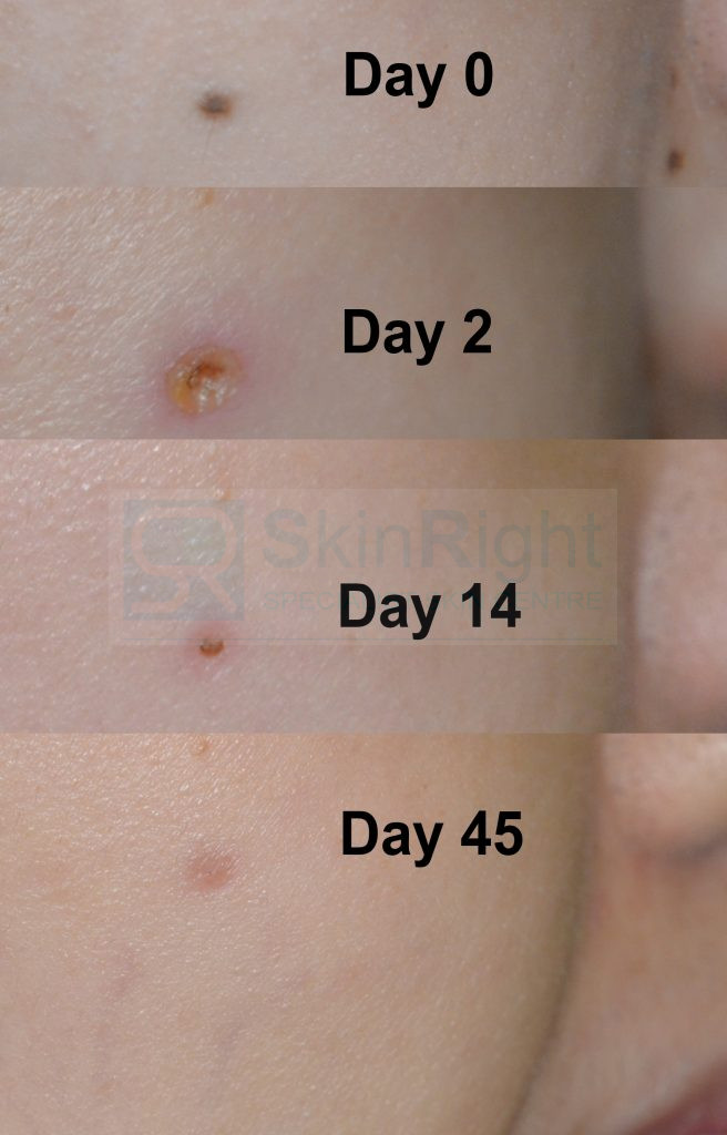 Mole excision recovery
