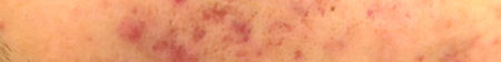 暗瘡印,acne scars